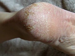 Lyn's Soles - Dry AGAIN!